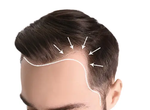 A Guide: The Best Haircuts for Receding Hair