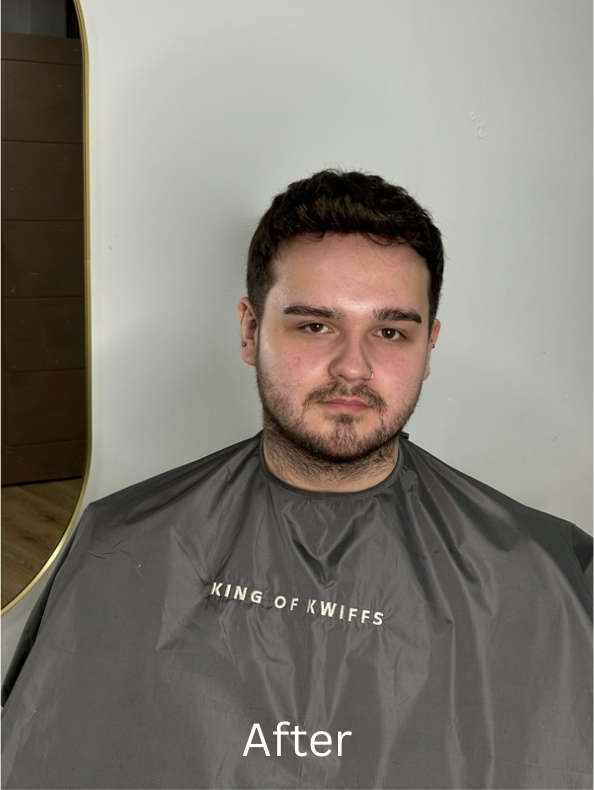 Hair Systems vs Hair Transplant