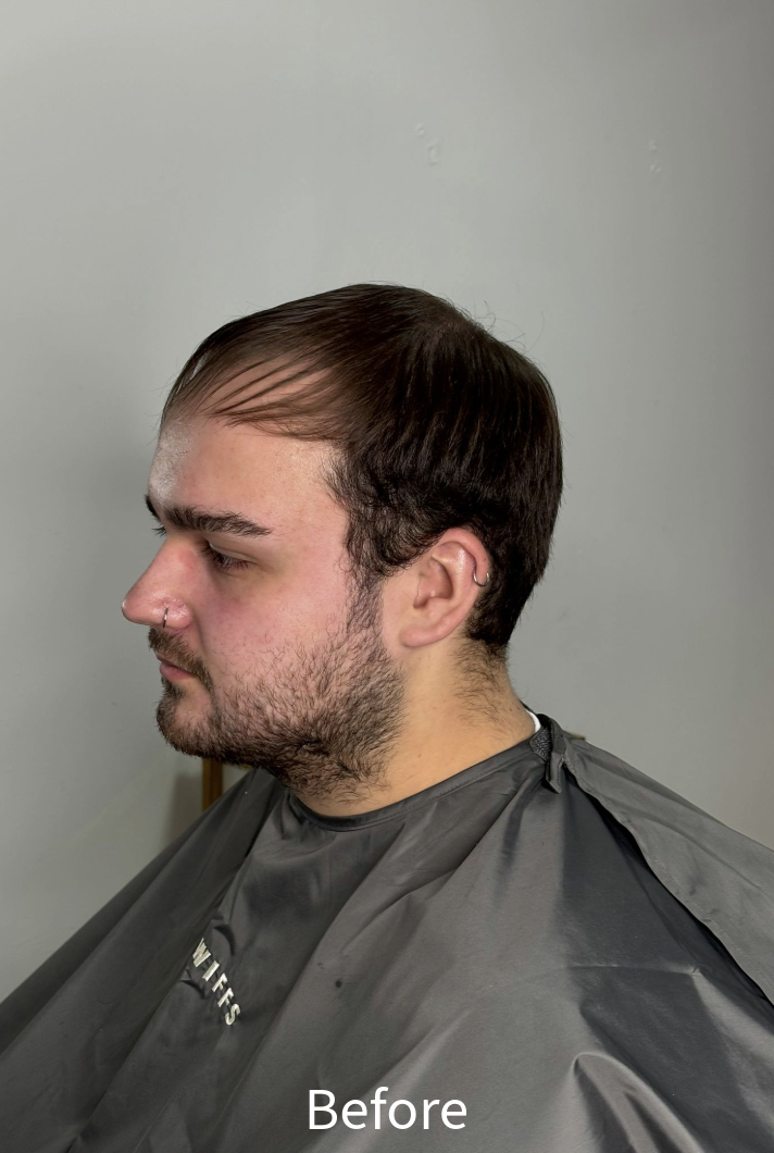 Before: client prior to hair system fitting