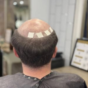 men's hair system before