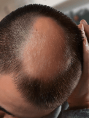 Screenshot 2024-12-17 at 12.50.36 alopecia, men's hair system